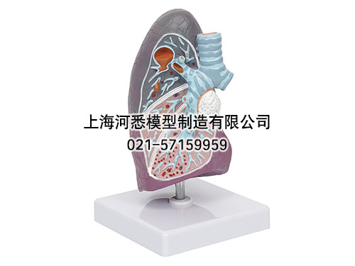 病理肺模型,肺部病变模型