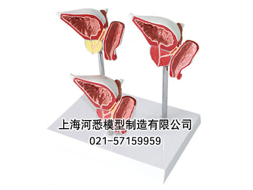 前列腺正常和病变演示模型
