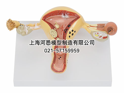 子宫卵巢病变模型
