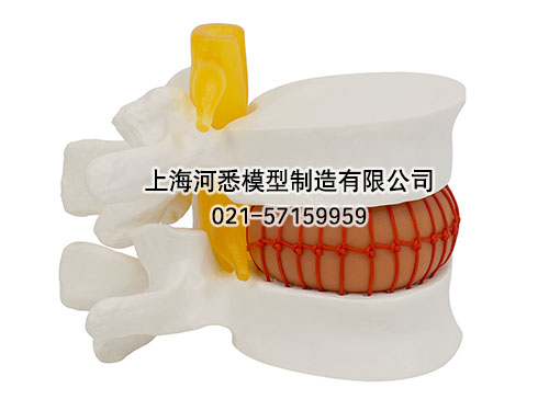 腰椎间盘突出演示模型,大腰椎带血球