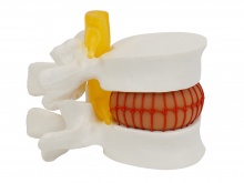 腰椎间盘突出演示模型（大腰椎带血球）
