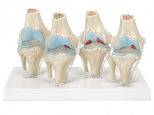 膝关节健康病态比较模型（4阶段膝关节病变模型）