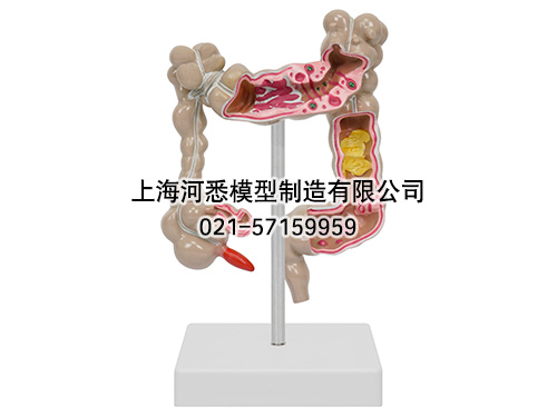 大肠病变模型