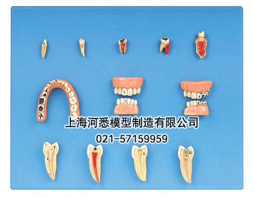 牙齿病变模型