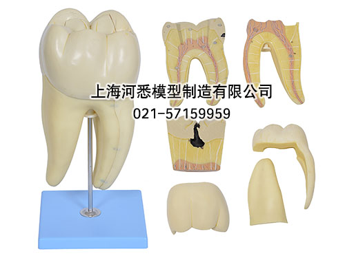 磨牙蛀牙解剖放大模型,右侧第一下磨牙蛀牙模型