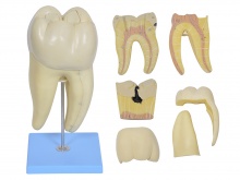 磨牙蛀牙解剖放大模型（右侧第一下磨牙蛀牙模型）
